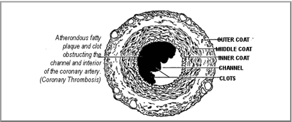 Atherosclerosis: Fig. 2