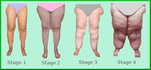 Lipedema - Stages